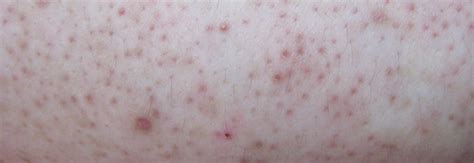 Eczema Vs Keratosis Pilaris Do You Know The Difference The Eczema