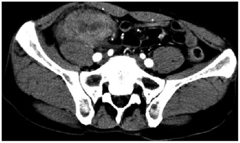 Computed Tomography Ct Findings Abdominal Ct Images Showed An