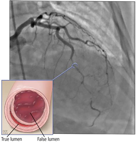 Spontaneous Coronary Artery Dissection An Often Unrecognized Cause Of