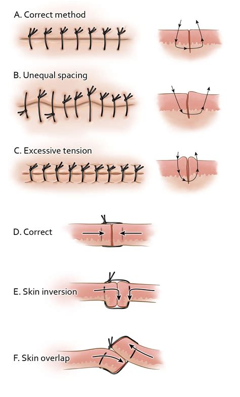 Suturing And Closure The Neurosurgical Atlas By Aaron Cohen Gadol Md