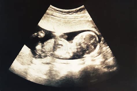 2d Ultrasound Photo Of Infant Baby In Womb With Age About 4 Months