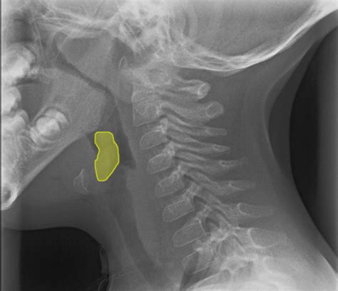 Normal Epiglottis Location Illustration Image