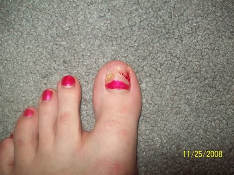 But can you really fix it? Cutting Toenail too short may cause infection - Nails Journal