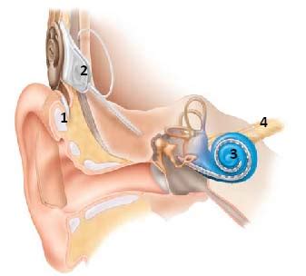 Cochlear Implant Systems OHSU