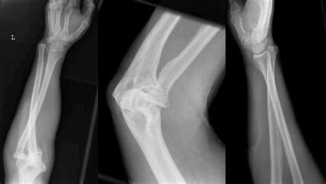 Radiographs Showing An Anterolateral Dislocation Of The Radial Head And
