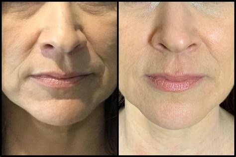 Facial Filler Before And After 05 Bella Vi