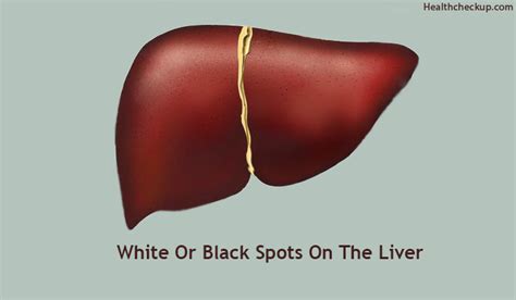 Black Or White Spots On Liver What Does It Mean Causes By Dr Himanshi