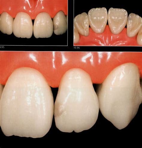 Class Iii Composite Restoration Labial Access Dental Esthetics