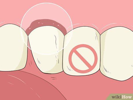 Home remedies for loose teeth. 3 Ways to Pull a Loose Tooth at Home - wikiHow