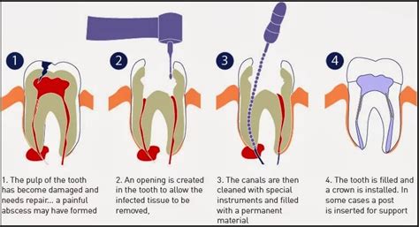 Root Canal Procedures Can Save Teeth In Mississauga St Lawrence