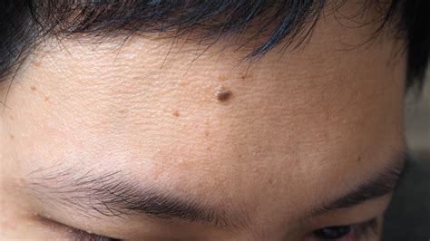 What It Means When You Have A Mole On Your Forehead