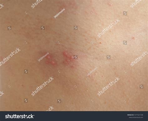Herpes Zoster Shingles Woman On Her Stock Foto 1577321728 Shutterstock