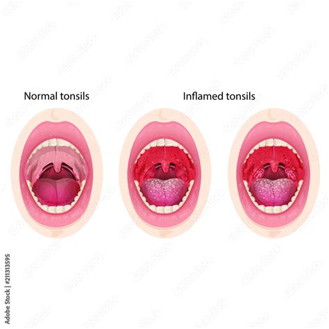 Normal And Inflamed Tonsils Stock Vector Adobe Stock