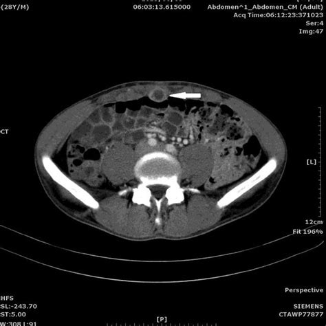 Abdominal Ct Scan Transverse View A 4 Cm Mass In The Subumbilical