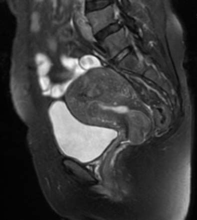 Cervical Polyp Radiology Reference Article Radiopaedia Org