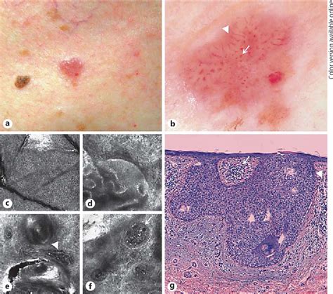 Figure 2 From Inverted Follicular Keratosis Dermoscopic And