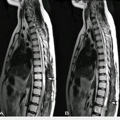 MRI Whole Spine Sagittal View A T Weighted And B T Weighted Download Scientific Diagram