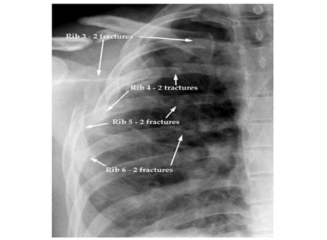 Flail Chest Chest X Ray In Pa View Showing Multiple Ribs Fracture