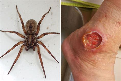 The Worst Spider Bite Pictures Including The Brown Recluse And Black Widow Mirror Online