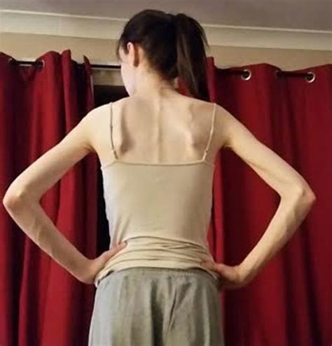 Anorexic Left Close To Death After Starving Herself On Just 17g Of Rice