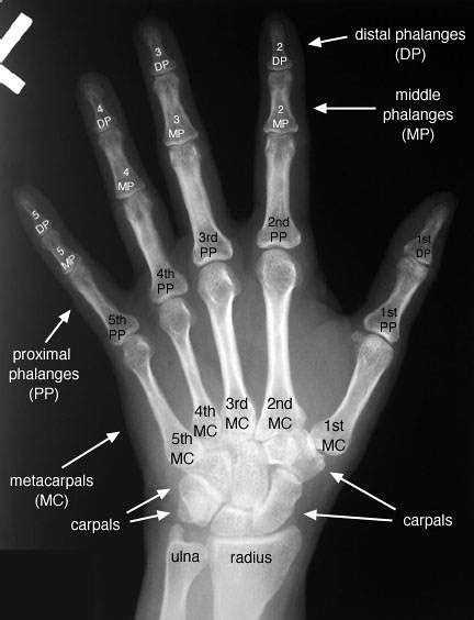 Hand Radiograph Anatomy