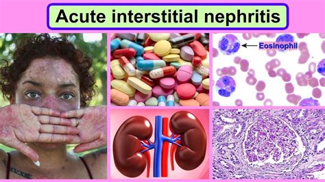 Acute Interstitial Nephritis Youtube