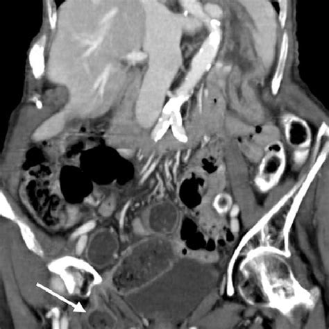 Axial Ct Image Shows Bilateral Obturator Hernias With Fluid In The