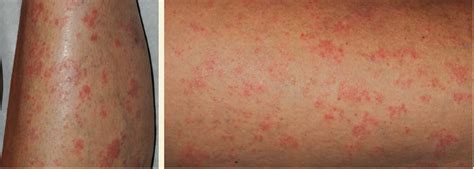 What Is The Cause Of This Patients Psoriasis Flare Consultant360