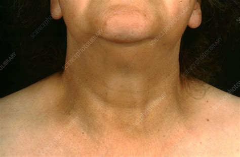 Hypothyroidism Swollen Neck Stock Image C0365590 Science Photo
