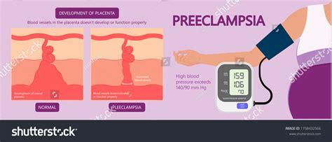 Preeclampsia Pregnancy Disorder Hypertension Toxemia Urine Stock Vector Royalty Free