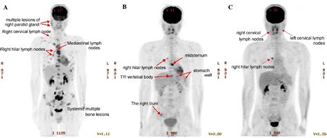 Primary Extranodal Head And Neck Classical Hodgkin Lymphoma A Rare