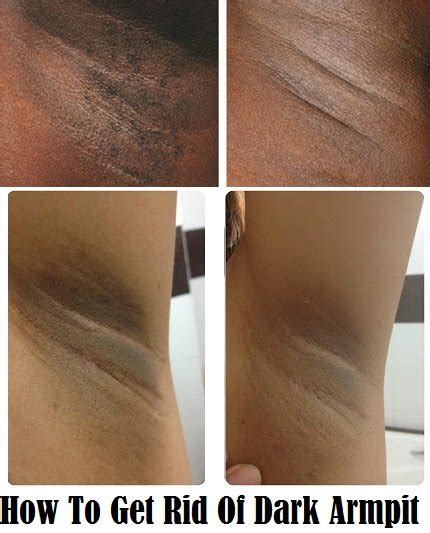 Naturally, the skin of your armpits should be about the same shade as the rest of your skin. የሰውነት መጋጠሚያ አካባቢ እና የብብት ጥቁረትን ለማስወገድ - ETHIOFORUM-ኢትዮፎረም