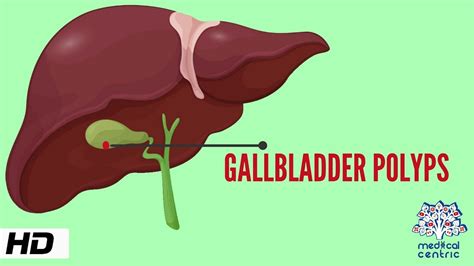 Gallbladder Polyp Causes Signs And Symptoms Diagnosis And Treatment