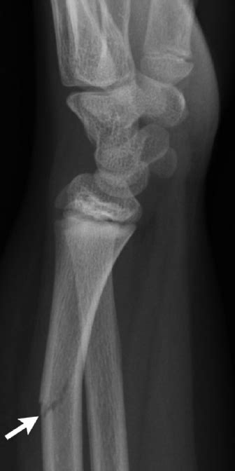 Lateral Radiograph Shows A Greenstick Fracture In A 10 Year Old Boy