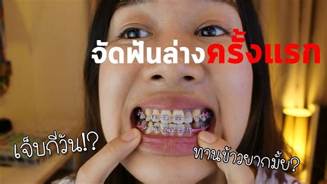 จัดฟันล่างครั้งแรก กี่วันทานข้าวได้ ความลำบากในการใช้ชีวิต Archii Youtube