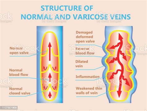 The Varicose Veins And Normal Veins Stock Illustration Download Image