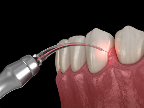 Laser Gum Disease Treatment Dentist Signature Smiles Dental