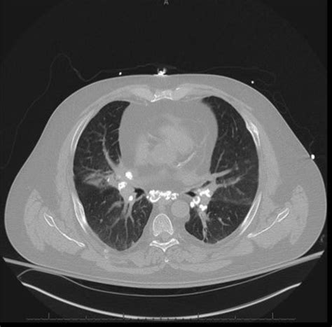 Noncontrast-computed tomography scan. This screenshot of the chest... | Download Scientific Diagram