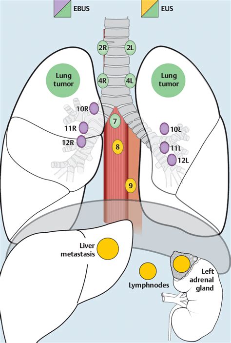 Llustration Of Mediastinal Lymph Node Stations And Abdominal Regions
