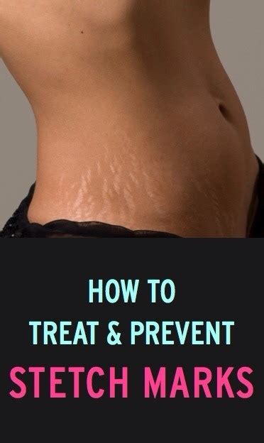 How To Treat And Prevent Stretch Marks Musely