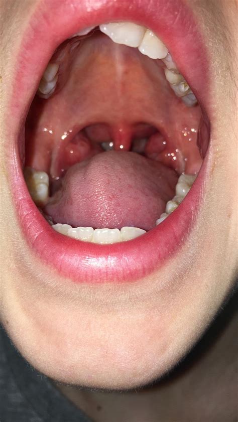Adenoids And Tonsils Louisa Ferguson FRCS