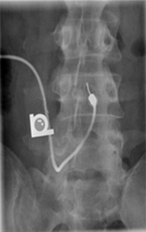 Fluoroscopically Guided Lumbar Puncture Ajr