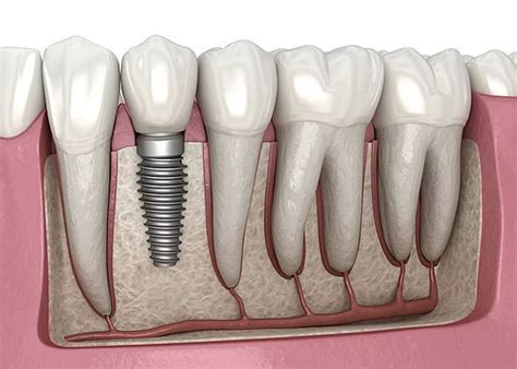 The Lifespan Of Dental Implants How Long Do Dental Implant Last