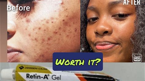 How To Get Rid Of Acne Using Retin A Gel Tretinoin 025 G Tretinoin