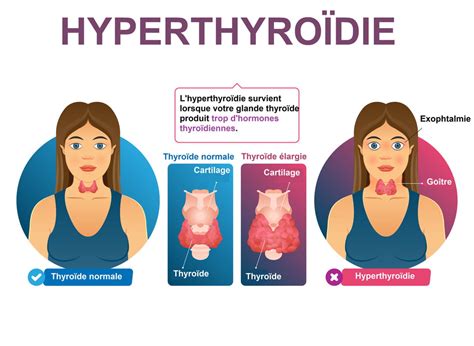 Hyperthyroïdie Symptômes Tsh Quelles Conséquences
