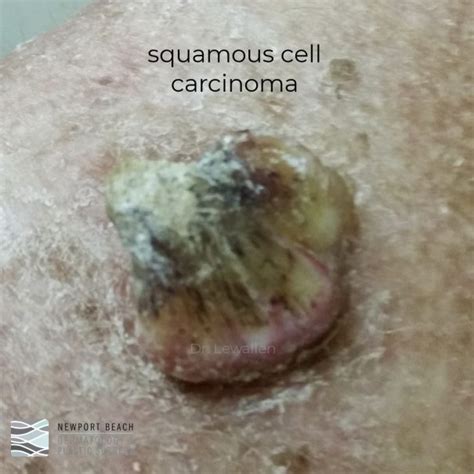 Squamous Cell Carcinoma Newport Beach Dermatology And Plastic Surgery