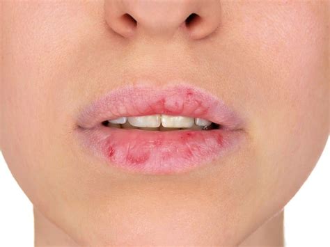 Dry Chapped And Cracked Lips — Waterview Dental
