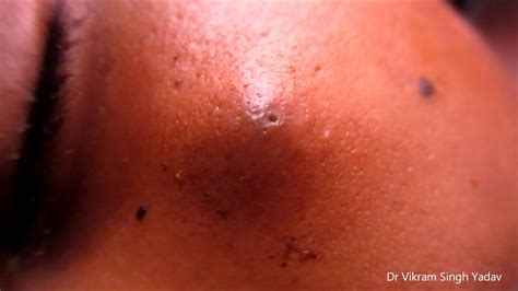 Skin Lumps Causes Symptoms Treatment Skin Lumps Sexiezpix Web Porn