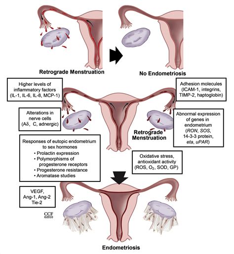 Endometriosis happens when the endometrium, tissue that usually lines the inside of your uterus, grows outside it. Figure 1 from Role of eutopic endometrium in pelvic ...