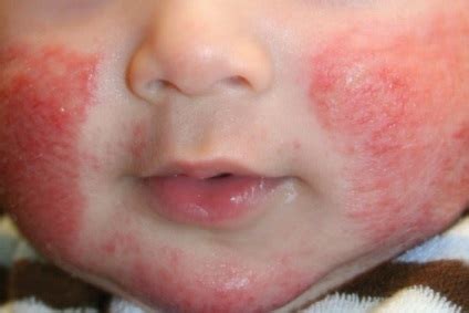 Dermatita Atopica Simptome Si Tratament La Copii Cum S Trateze Copilul